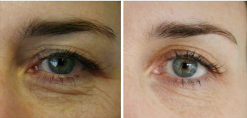 Коррекция области вокруг глаз на аппарате NEOCEN. До и через 2 месяца после процедуры. Фотографии до и после