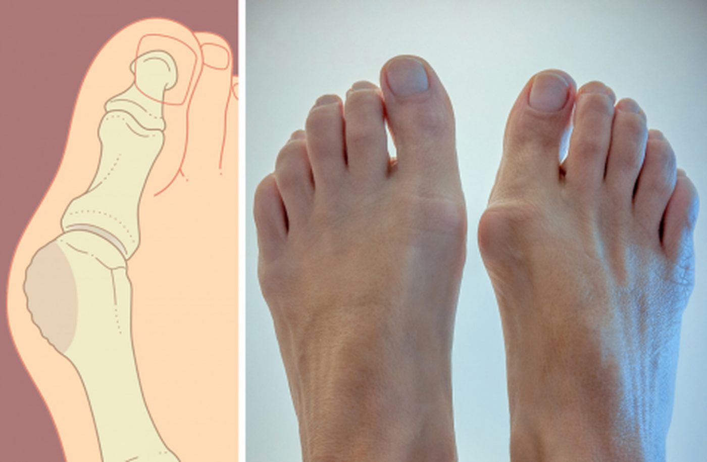 Вальгусная деформация пальца стопы. Лечение косточки на ногах во Владивостоке
