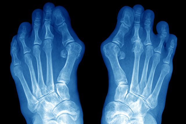Рентген-диагностика стопы во Владивсотоке при деформации стопы