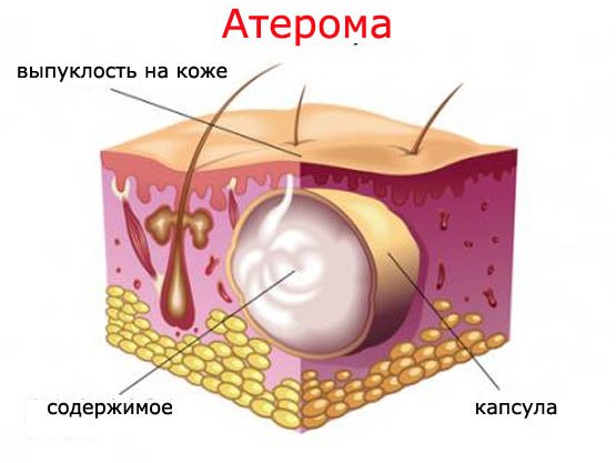Лечение атеромы во Владивостоке
