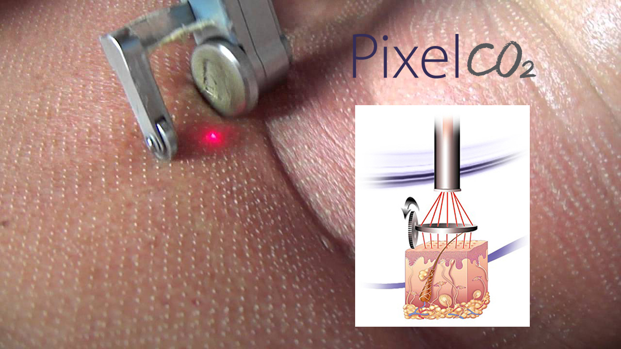Процедура фракционного лазерного омоложения iPixel CO2