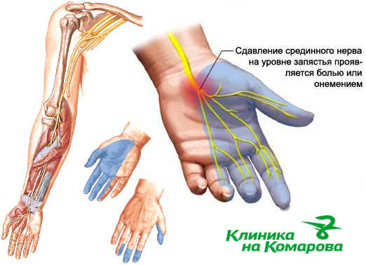 Диагностика повреждений нервов кисти во Владивостоке