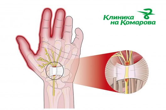 Лечение повреждений нервов кисти во Владивостоке