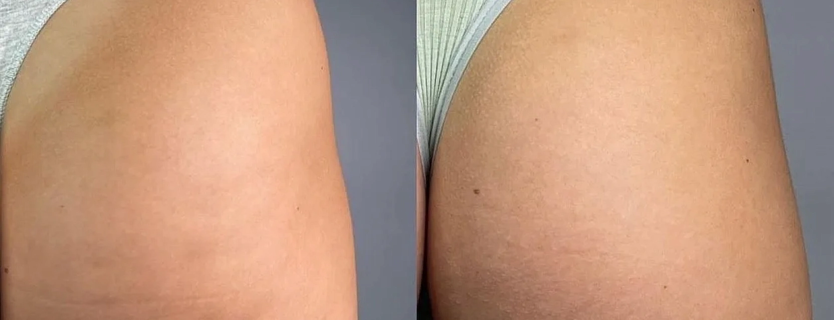 COOLSHAPING - передовая методика коррекции фигуры