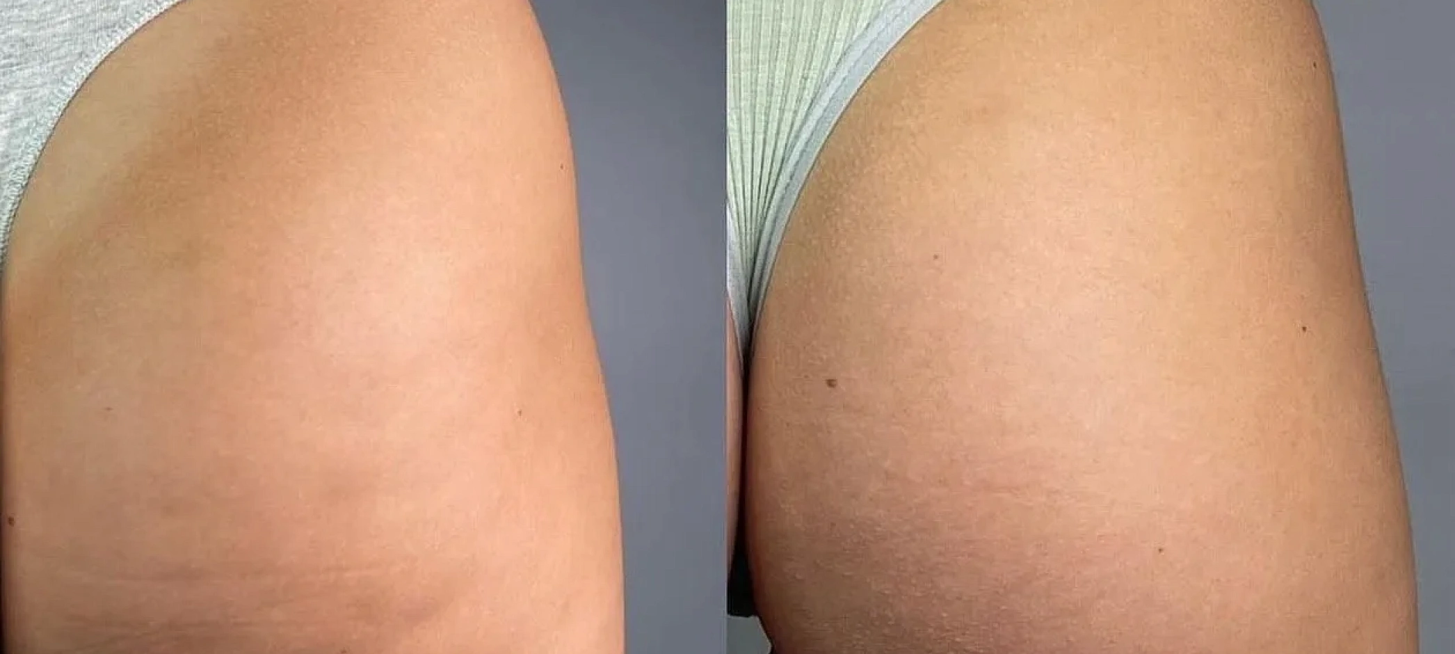 COOLSHAPING - передовая методика коррекции фигуры